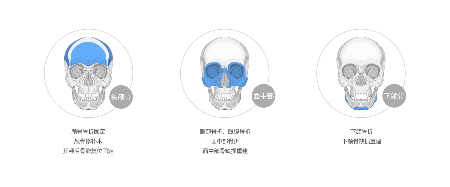聚醚醚酮顱頜面固定板應(yīng)用