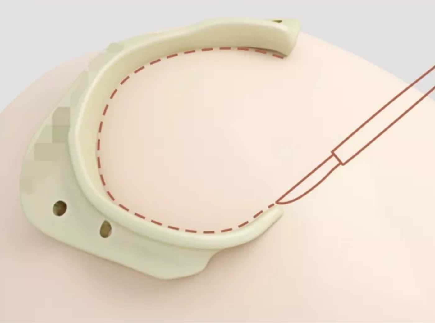 當顱骨修復遇上3D手術導板，完美match！