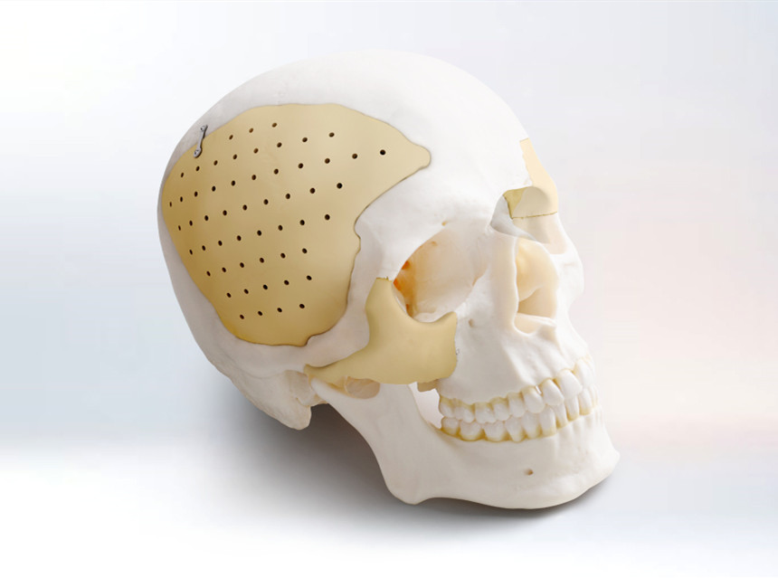 “腦洞”大開？顱骨修補幫你忙！