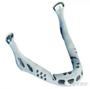 3D打印技術在骨科個體化治療方面的優勢和應用