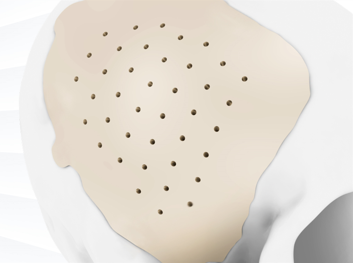 顱骨修補材料大PK！學術文獻回顧探究PEEK強在哪